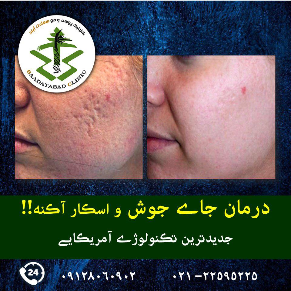 درمان جای جوش صورت