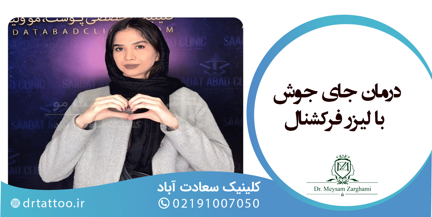درمان جای جوش با لیزر فرکشنال