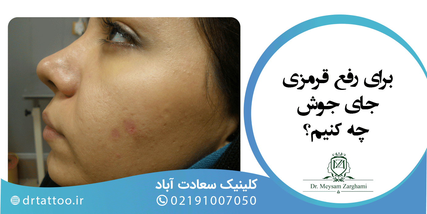 برای رفع قرمزی جای جوش چه کنیم؟