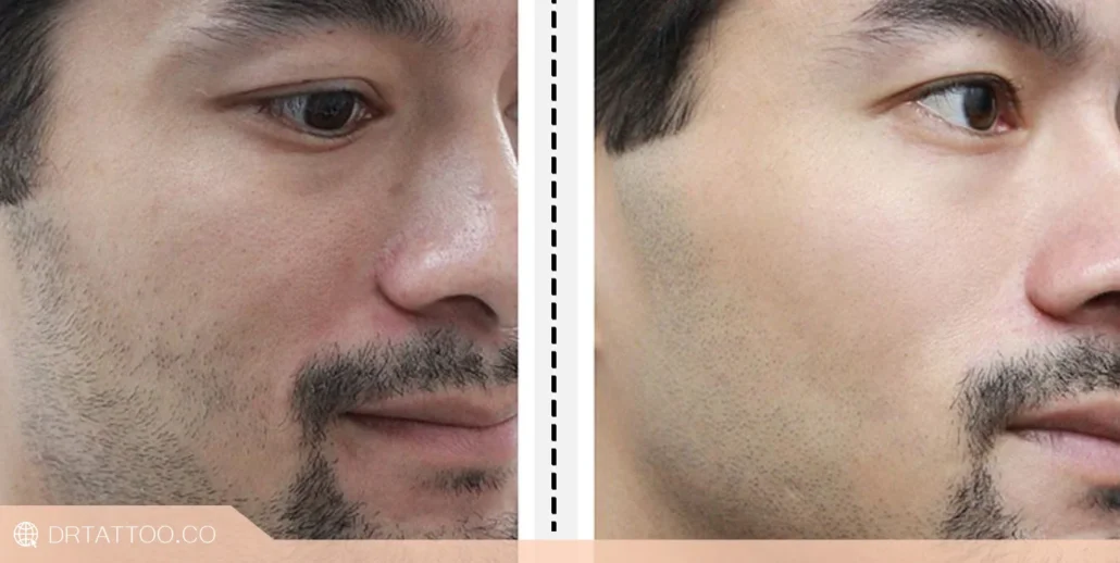 قبل و بعد لیزر اربیوم برای منافذ پوست