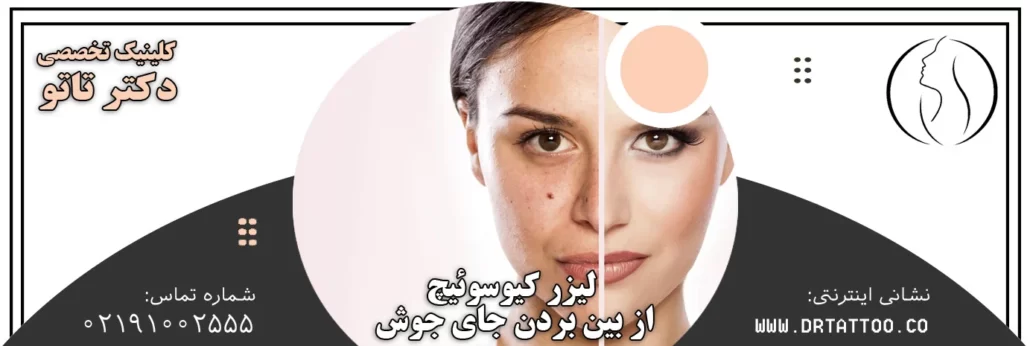 لیزر کیوسوییچ برای جای جوش