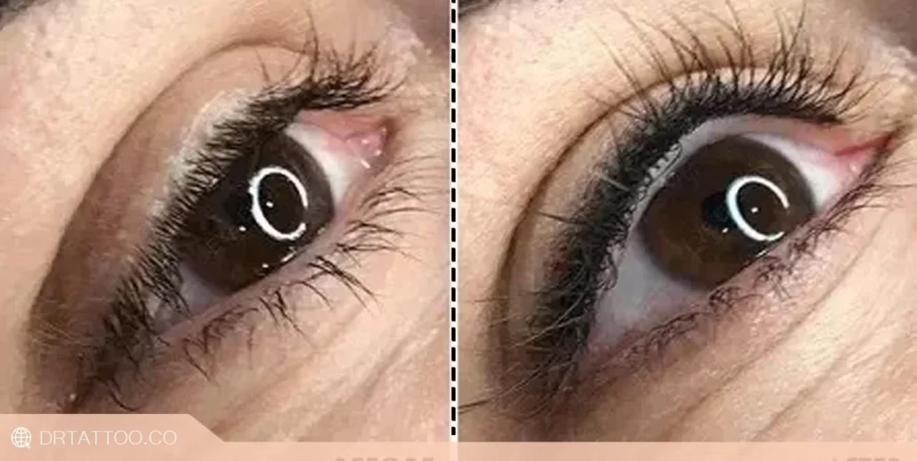 قبل و بعد پاک کردن تاتو خط چشم