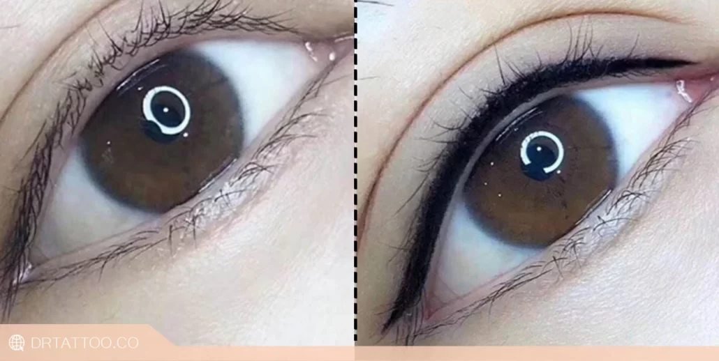 قبل و بعد پاک کردن تاتو خط چشم با لیزر