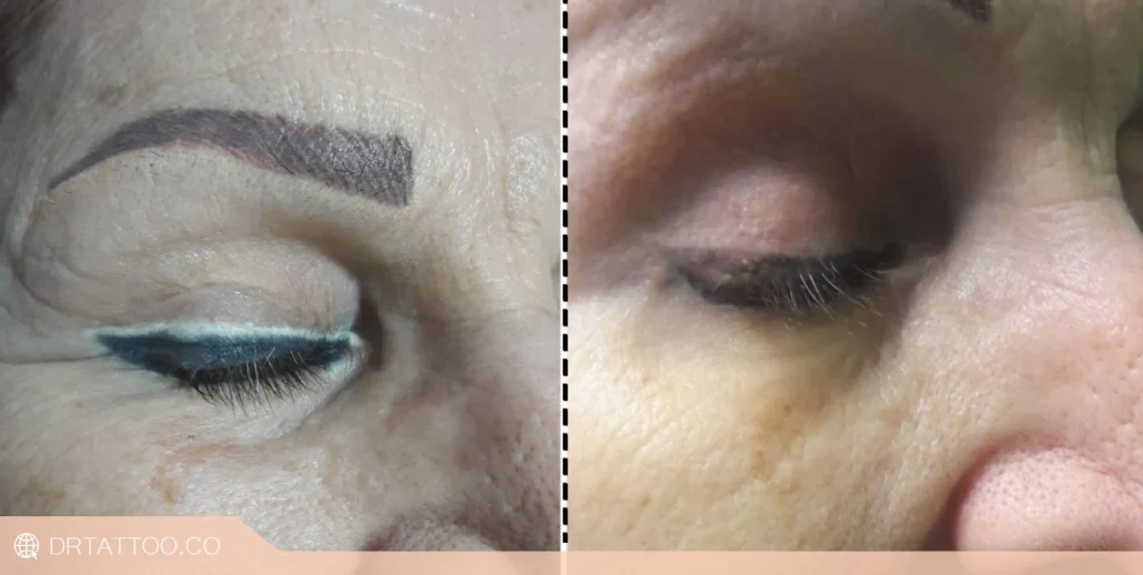 قبل و بعد لیزر به عنوان بهترين روش پاک کردن تاتو خط چشم