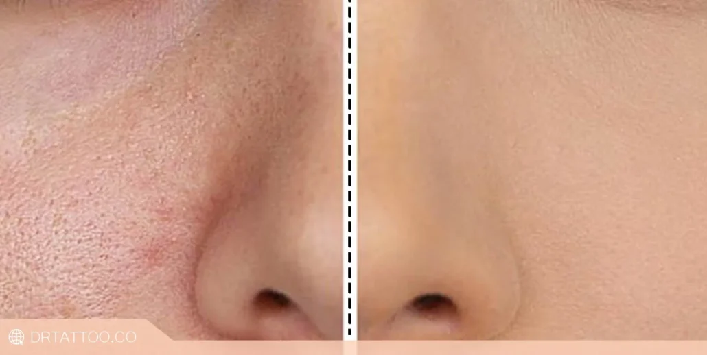 قبل و بعد درمان منافذ باز پوست با میکرونیدلینگ