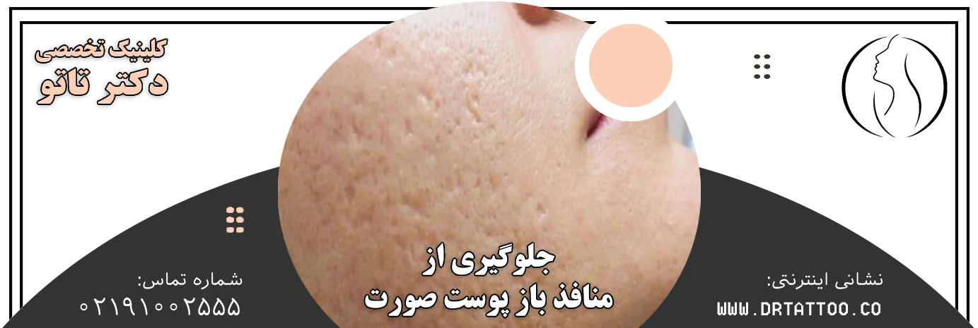 جلوگیری از منافذ باز پوست صورت