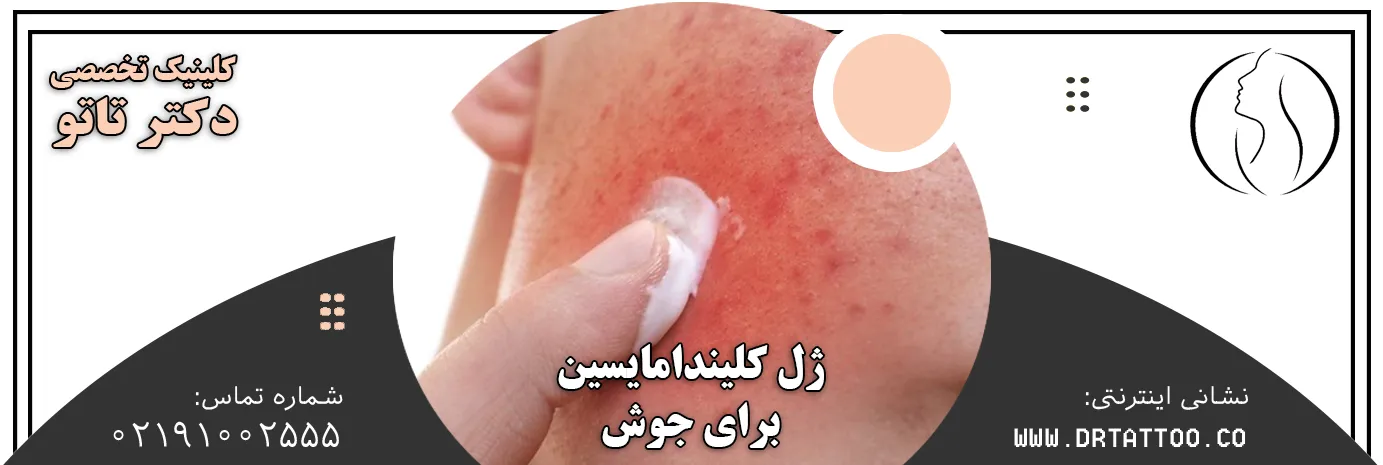 ژل کلیندامایسین برای جوش