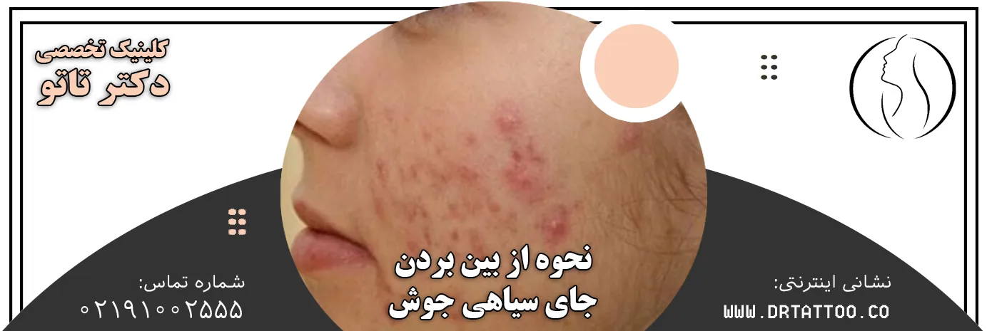 نحوه از بین بردن جای سیاهی جوش صورت