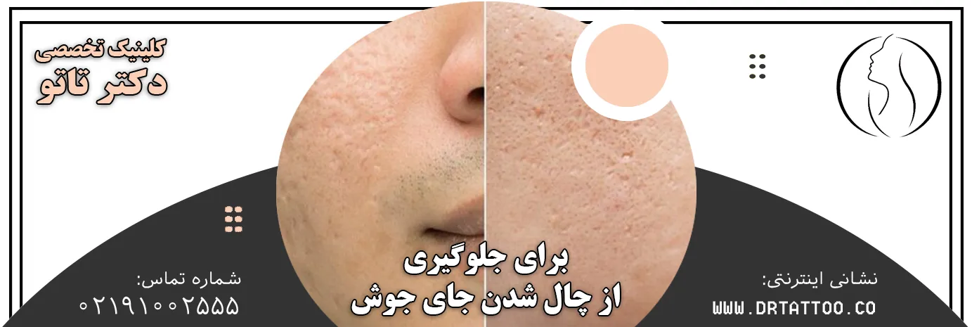 برای جلوگیری از چال شدن جای جوش