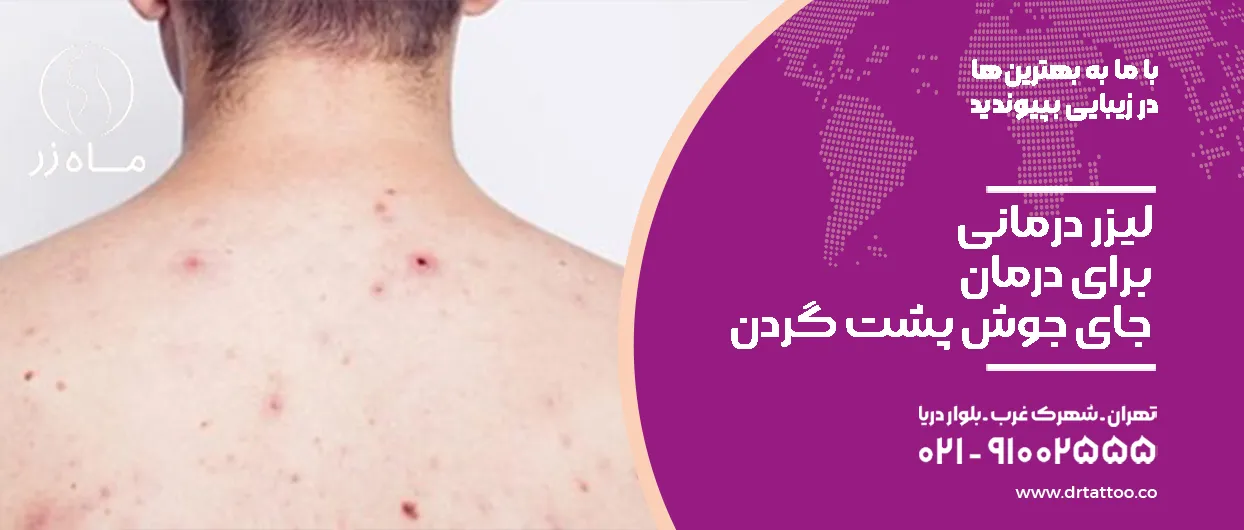 لیزر درمانی برای جای جوش گردن