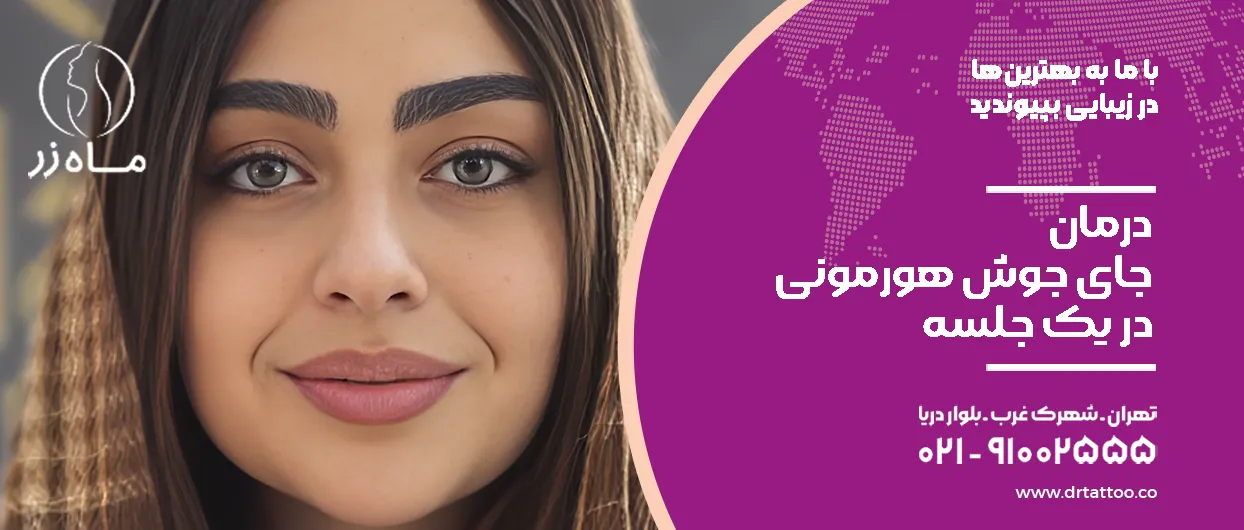 درمان جای جوش هورمونی در یک جلسه
