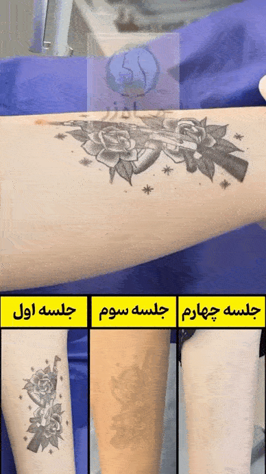 مراقبت بعد از اربیوم ریموو تتو