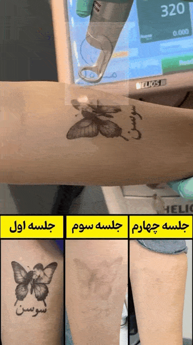 مزیت پاک کردن تاتو با لیزر اربیوم