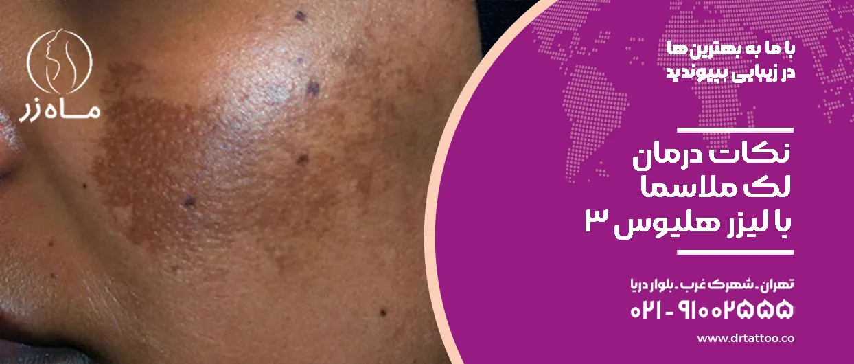 نکات درمان لک ملاسما با لیزر هلیوس ۳