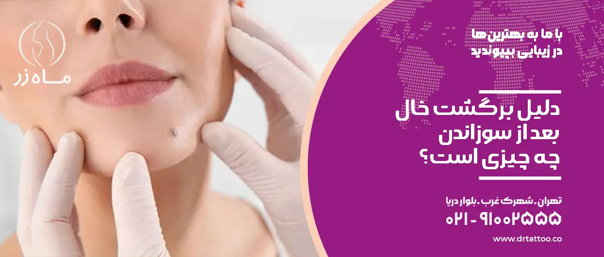 دلیل برگشت خال بعد از سوزاندن
