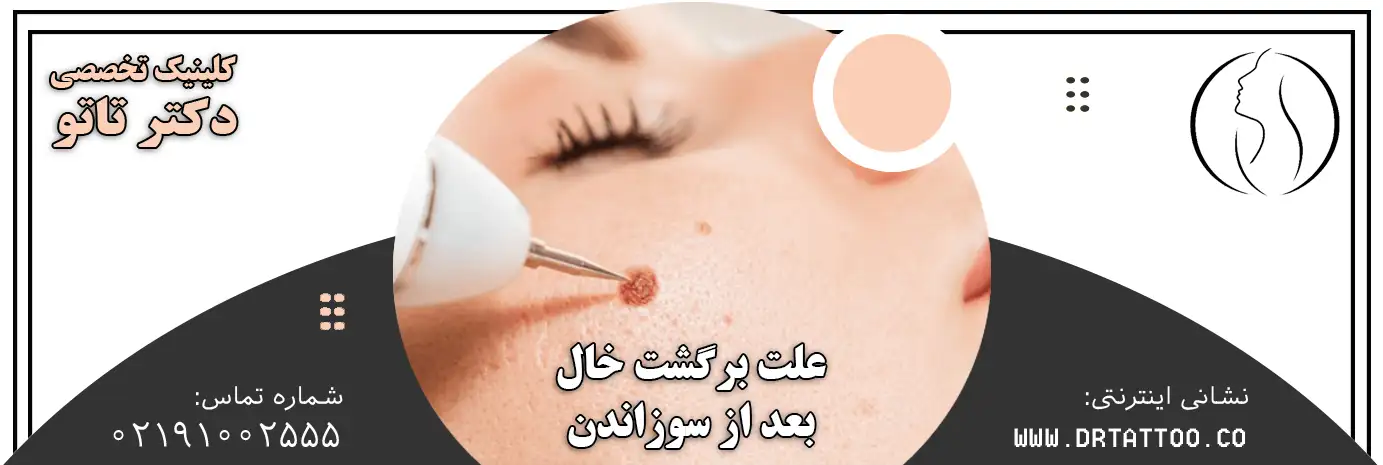 علت برگشت خال بعد از سوزاندن