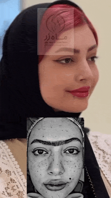 مراقبت‌های بعد از لیزر کم توان جوانساز
