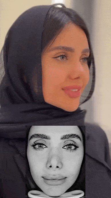 مزایای لیزر اربیوم در رفع کک مک