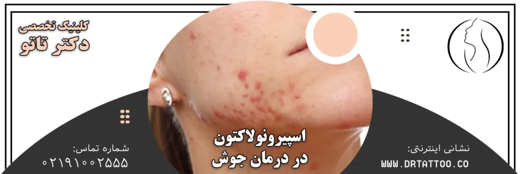 اسپیرونولاکتون در درمان جوش