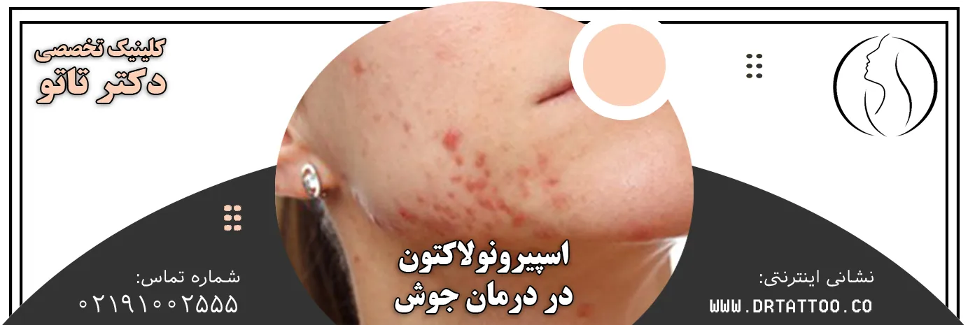 اسپیرونولاکتون در درمان جوش