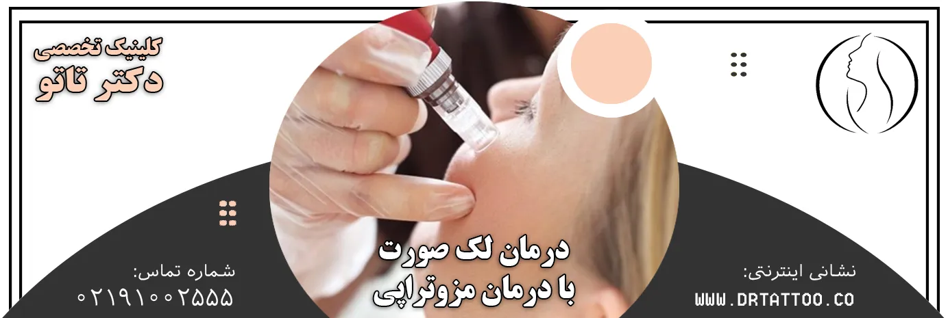 درمان لک صورت با مزوتراپی