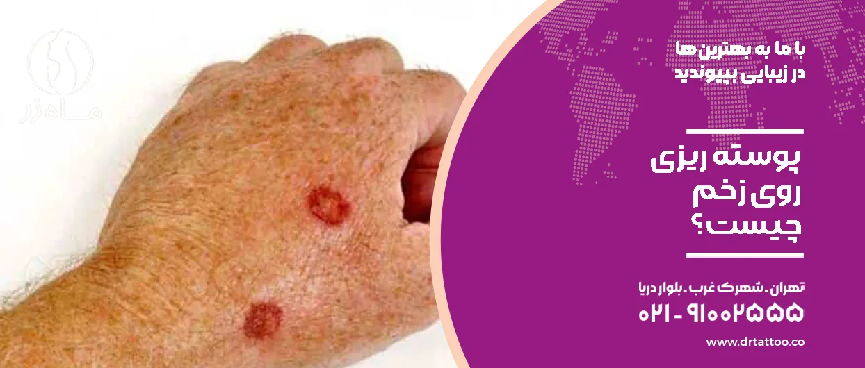 علت پوسته ریزی روی زخم چیست؟
