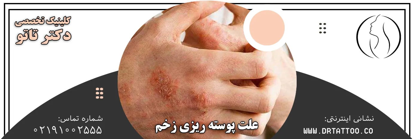 علت پوسته ریزی زخم