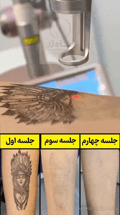 کلینیک لیزر تاتو شهرک غرب