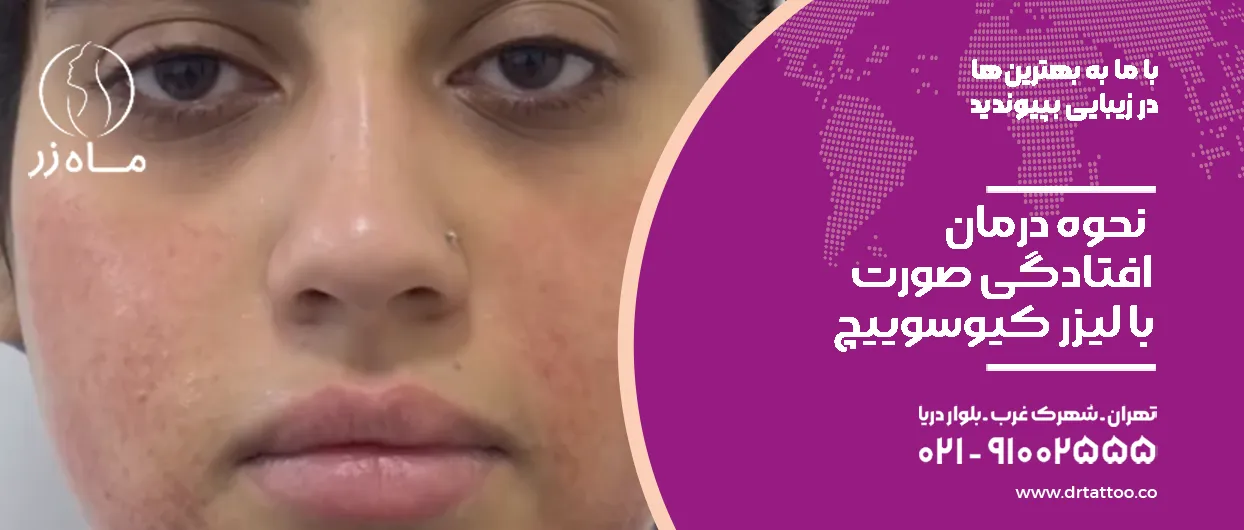 نحوه درمان افتادگی صورت با لیزر کیوسوییچ