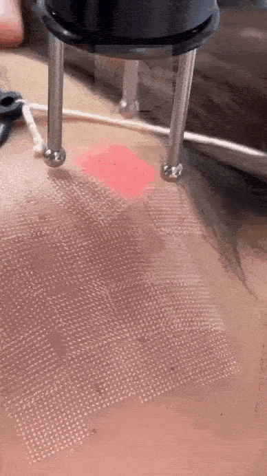 درمان ملاسما با لیزر کیوسوییچ