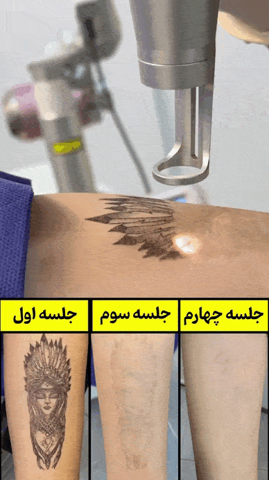 آیا پاک کردن تاتو باعث آسیب پوست می‌شود؟