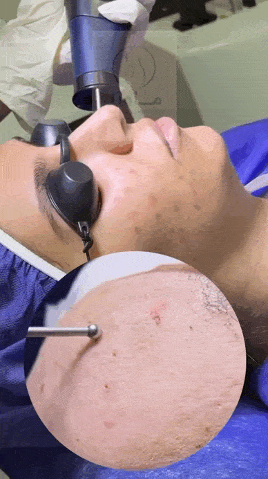 روش‌های ترکیبی درمان اسکار عمیق