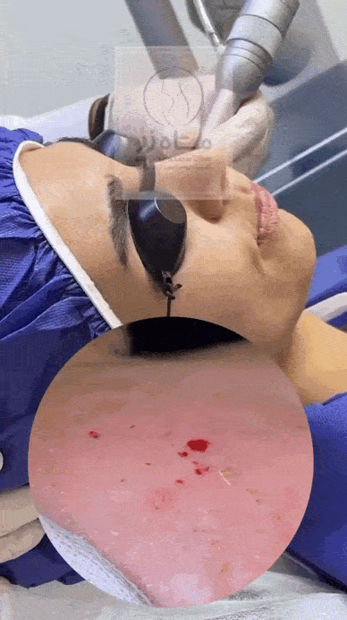 هزینه درمان اسکار نسبت به روش درمان