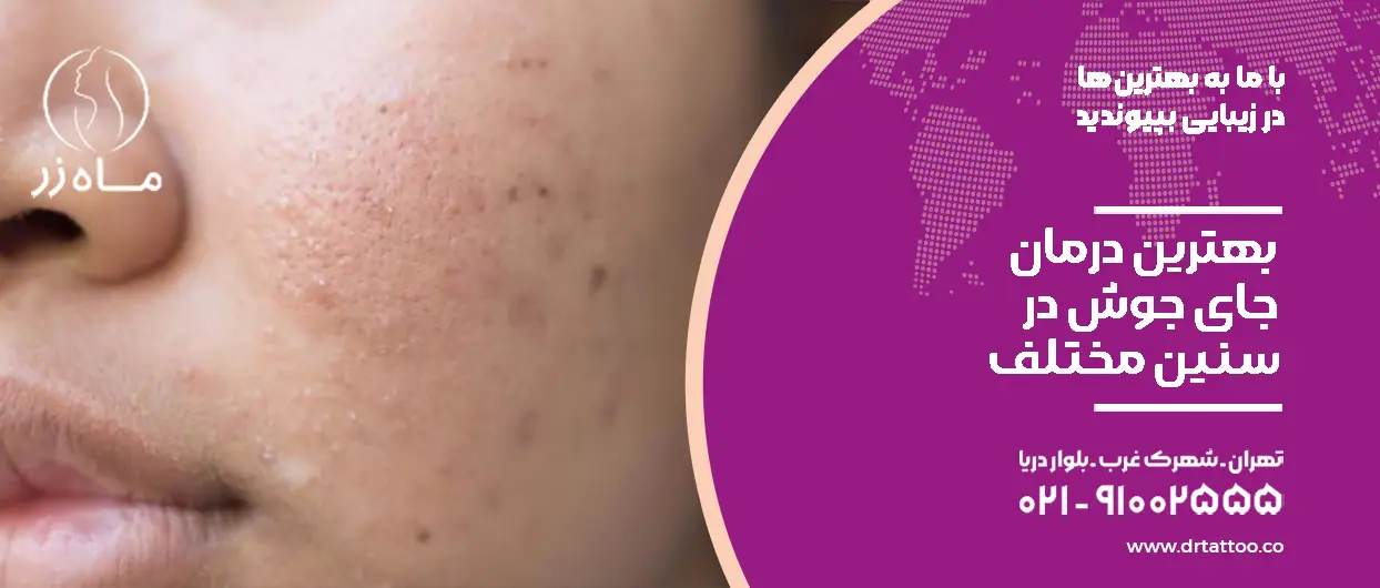 بهترین درمان جای جوش در سنین مختلف