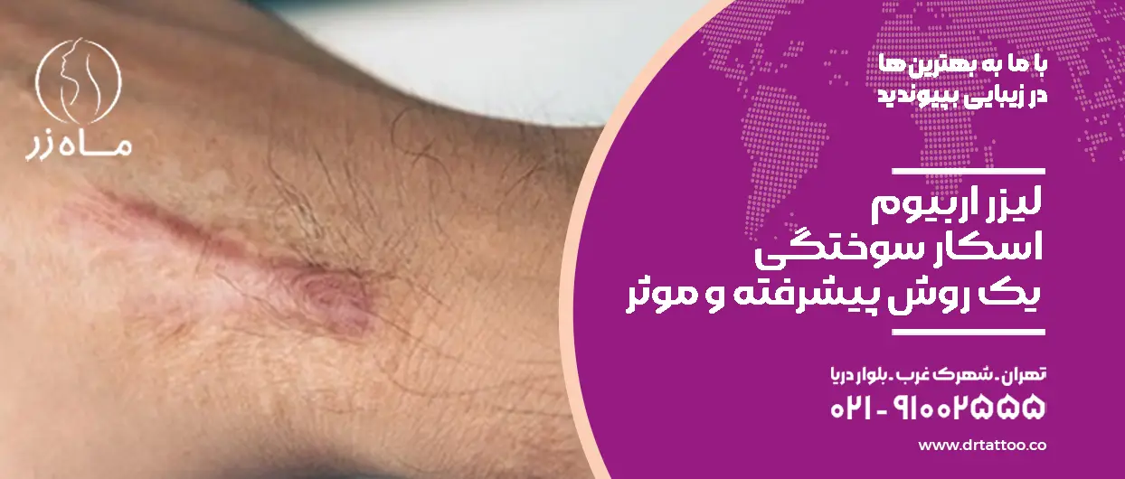 درمان لیزر اربیوم با اسکار سوختگی