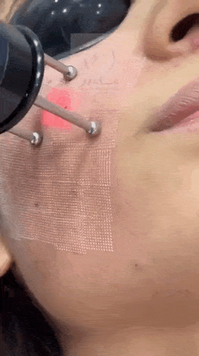 لیزر کیوسوییچ برای جای جوش