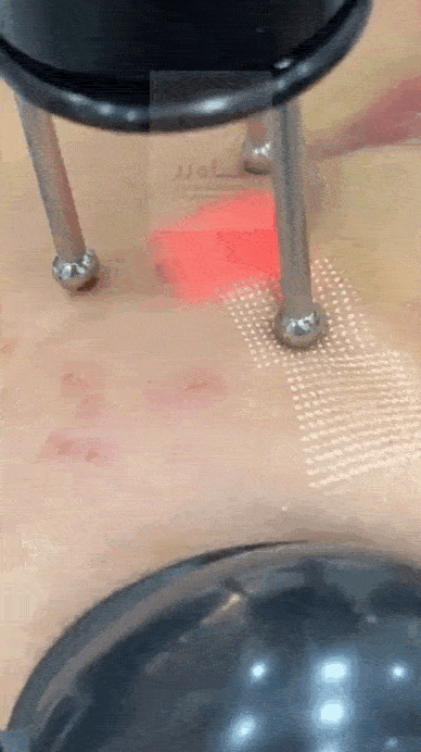 مقایسه میکرونیدلینگ و لیزر CO2 برای جای جوش